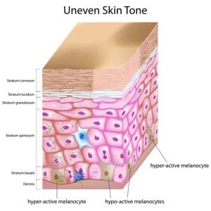 Post-inflammatory Hyperpigmentation
