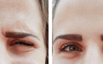 Botox®: What is it and how does it work?