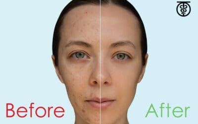 Is a chemical peel good for my skin?