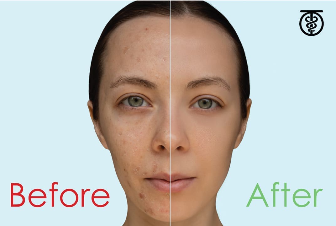 Is a chemical peel good for my skin?