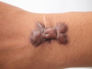 What to do about an inflamed, raised, hard scar