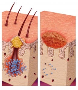 If you get a sore or scar on your scalp does it always cause permanent hair loss?